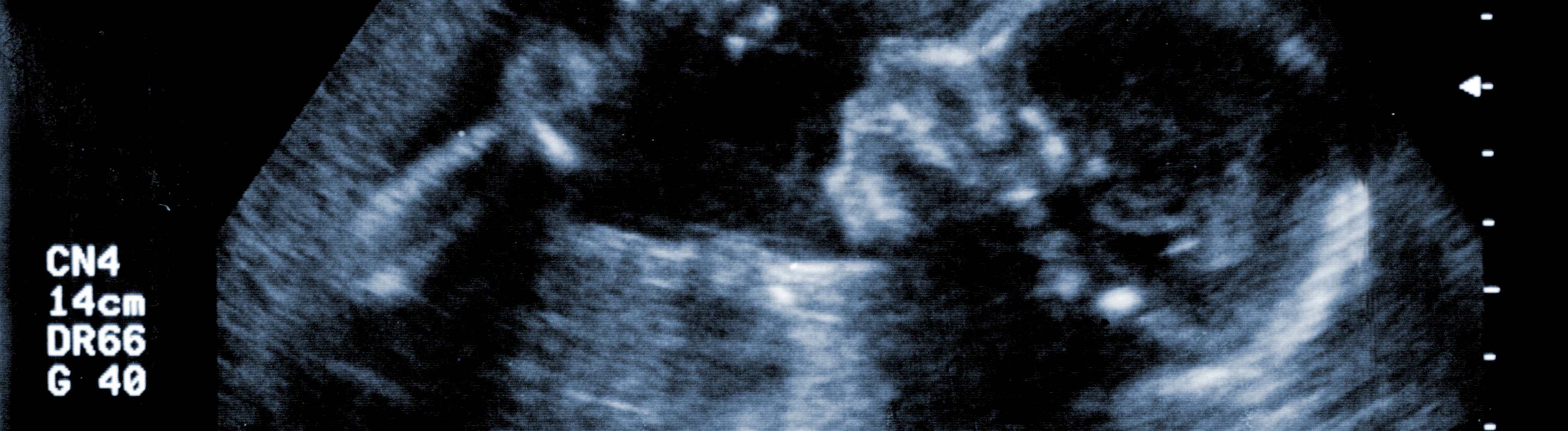 13 Week Pregnancy Symptoms What To Expect In Your Second Trimester 13-week-pregnancy-symptoms-what-to-expect-in-your-second-trimester